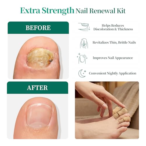 APUREE Fungal Nail Patches - Extra Strength 1% Tolnaftate, 32 Patches