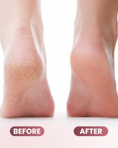 Electric Foot Callus Remover with Ice Compress & 50 Discs