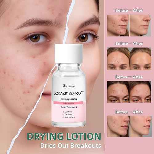Premium Acne Spot Drying Lotion with Swab, Overnight Acne Treatment For Face, Dry Out Pimples, Blemishes, Zits And Clean Pores, 12ml / 0.41 FlOz