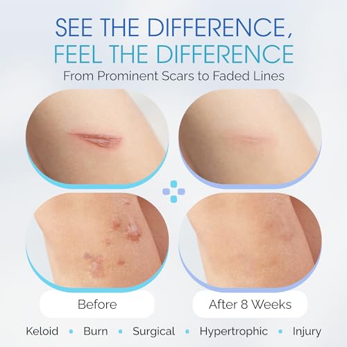 7¡± Medical Grade Reusable Silicone Scar Sheets for Surgical Scars & Stretch Marks ? Water-Resistant Breathable Silicone Scar Strips, 12-Pack (Approx. 90-Day Supply)