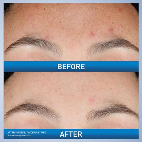 CeraVe Resurfacing Retinol Serum for Post-Acne Marks