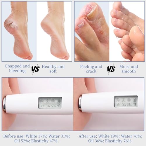 Urea Cream 70% & Salicylic Acid 2% - Dry Cracked Foot Repair Cream, 10.1 oz