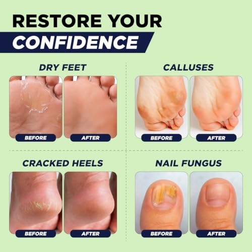 4-in-1 Foot Spa Kit: Callus Remover Gel, Foot Soak & Cream