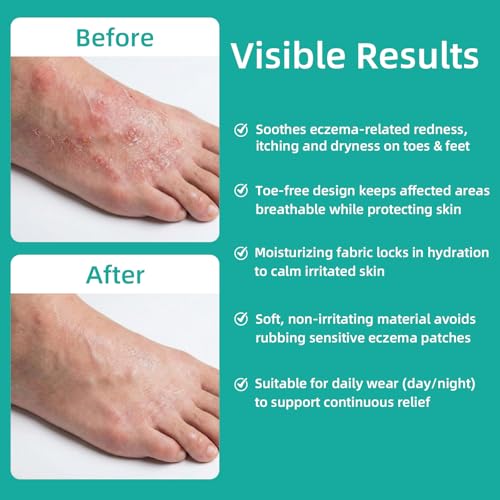 Shyyween Cotton Open-Toe Eczema Socks for Moisturizing Foot Therapy, 4-Pack