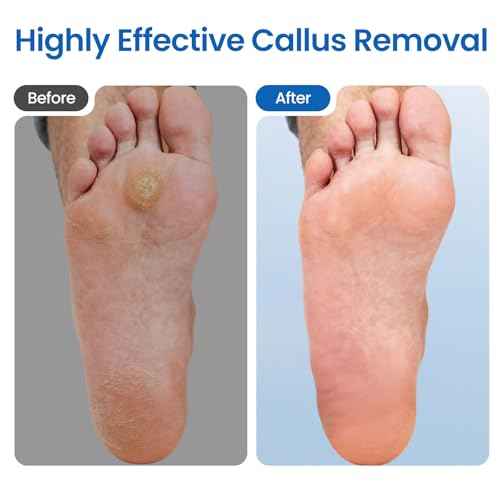 Electric Foot Callus Remover-60pcs Replacement Sandpaper Discs, 1200RPM Speed Adjustment, Metal Body, Callus & Dead Skin Removal