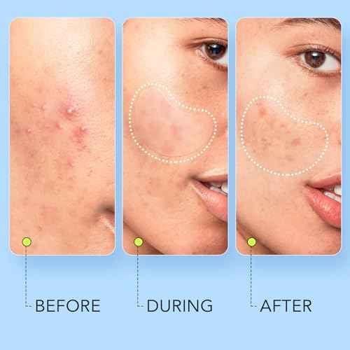 LitBear Large Pimple Patches (7 Sizes 112 Counts), Big Acne Patches, XL Hydrocolloid Bandages for Full Face, Forehead, Chin, Nose, Body, Back, Neck & Chest, Oval, Moon, Square hydrocolloid Patch