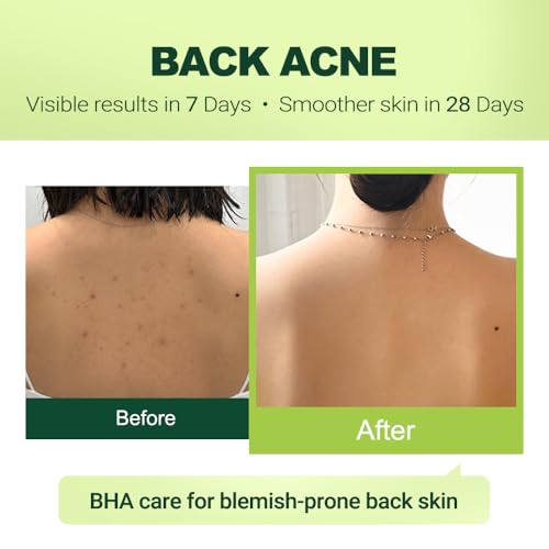 2% Salicylic Acid (BHA) Serum for Acne & Blackheads - Unclogs Pores, Oil Control, Sensitive-Skin Safe, Fragrance-Free,1 fl.oz