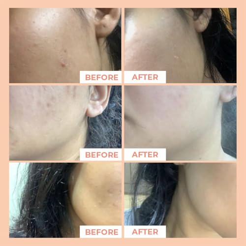 Leal Brightening Facial Oil, Rosehip Glow Face Oil, Rose Hip Drops, Pigmentation & Dark spots, Rose Squalane Oil For Face, Squalane Oil with Vitamin E - 25ml