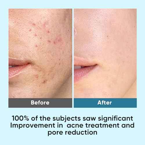 Elvira Glycolic Acid Exfoliating Facial Pads With 10% Glycolic Acid, 2% Salicylic Acid & Niacinamide - 60 Toner Pads, Daily Peel Treatment for Acne Prone Sensitive Skin