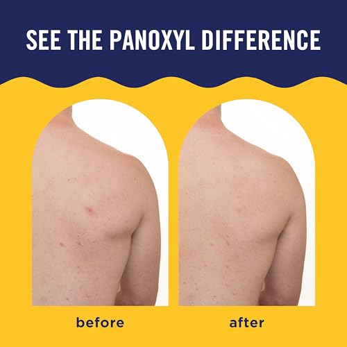PanOxyl Acne Banishing Body Spray 2% Salicylic Acid 6oz