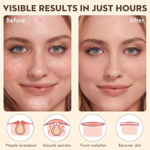 Pimple Patches for Face ? Hydrocolloid Acne Patches Set with 4.5ml Liquid Pimple Patch,with Tea Tree, Salicylic Acid 2 Sizes (9mm & 12mm) for Day & Night Skincare | 144 count