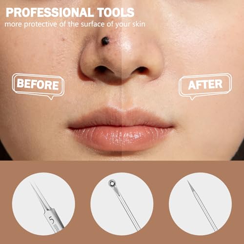 Blackhead Remover Tool Kit 6-Piece Stainless Steel Pimple Extractor