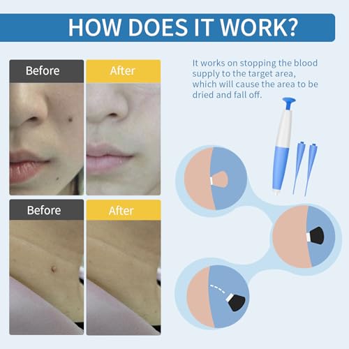 Midjustty Dual-TROL Skin Tag Removal Kit for Home Use