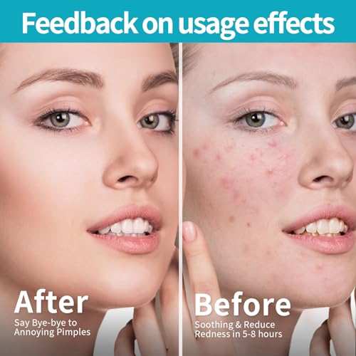 Pimple Patches for Face (1296 Count),3 shapes (Round,Star and heart Shapes),Hydrocolloid Spot Dots with Salicylic Acid and Tea Tree Oil