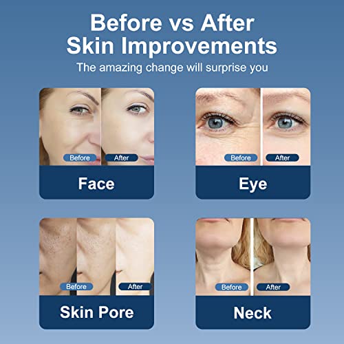 MiSMON High Frequency Facial Machine, 5 in 1 Mutifunctional Facial Massager Skin Tightening Light Theraphy Machine for Face