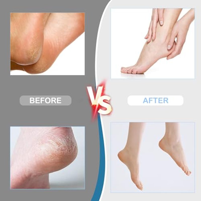 Electric Foot Callus Remover with Adjustable Speed & 60 Sandpaper Discs