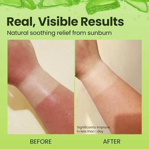 Honeyskin Aloe Vera Gel 8 Fl Oz - Soothing Sunburn & Dry Skin Relief
