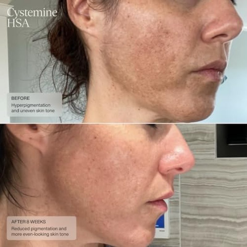 Senté Cysteamine HSA Dark Spot Corrector Cream - 1.7 Fl Oz