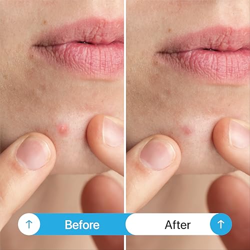 Pimple Patches (102 Count) ? Ultra-Thin Hydrocolloid Acne Patches for Face & Skin, Invisible Zit Stickers for Blemishes & Breakouts, Spot Treatment Dots, Vegan & Cruelty-Free Skincare