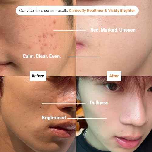 Pur?el 20% Vitamin C Serum for Face ? Brightening Serum with Vitamin E & Ferulic Acid ? Anti-Aging, Dark Spot Remover, Even Skin Tone, Wrinkle Reduction & Radiant Glow ? 1 fl oz