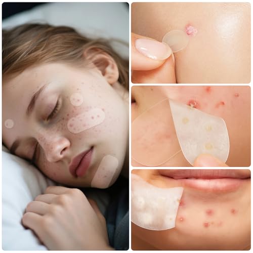 Pimple Patches for Face, 368 Counts 5 Sizes Large Patches, Hydrocolloid Blemishes Patch, Spot Dots Cover for Body, Chin, Cheek Zits & Blemish & Breakouts