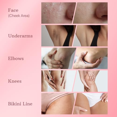 ESSENLIS Dark Spot Remover for Face, Body, Underarms, Armpit, Knees, Elbows, Sensitive Area, Promotes Anti-Aging Effect, Dark Spot Corrector for Women and Men