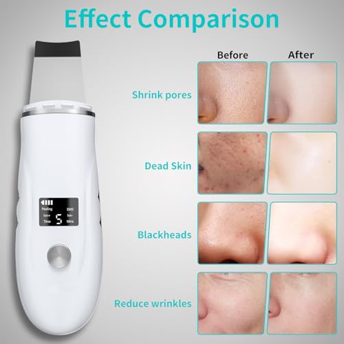 Face Spatula Blackhead Remover - 4 Modes Skin Scrubber