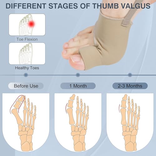 KTSAY Bunion Corrector Splint - 2PCS Adjustable Big Toe Straightener