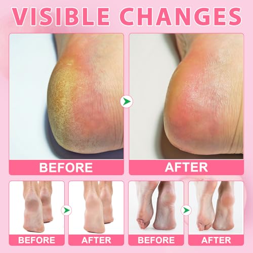 Urea Cream 60% Salicylic Acid Foot Balm Stick for Dry Cracked Heels