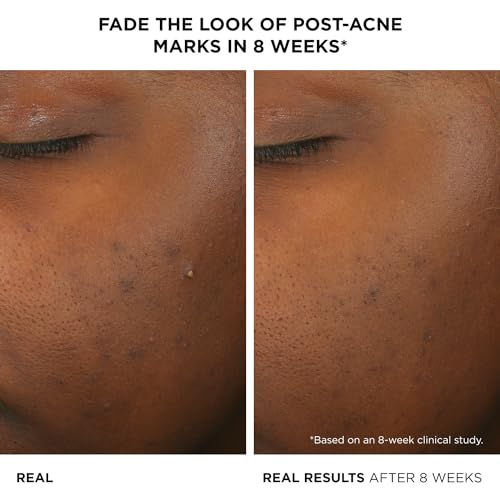 IT Cosmetics Bye Bye Breakout Acne Treatment Face Serum -With 2% Salicylic Acid & 3% Lactic Acid - Helps Reduce Pimples in 3 Days & Fades Look of Post-Acne Marks in 8 Weeks - 1 Fl. Oz