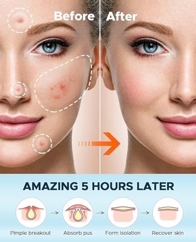 Invisible Acne Patches 400 Count - Fast-Acting Pimple Treatment