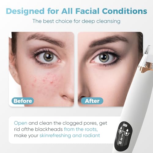 Gacavks Blackhead Remover Pore Vacuum - USB Rechargeable Facial Cleaner