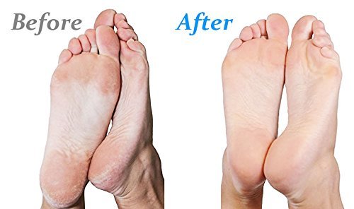 Callus Remover - Emjoi Micro-Pedi 3D POWER with SoftFlex Roller