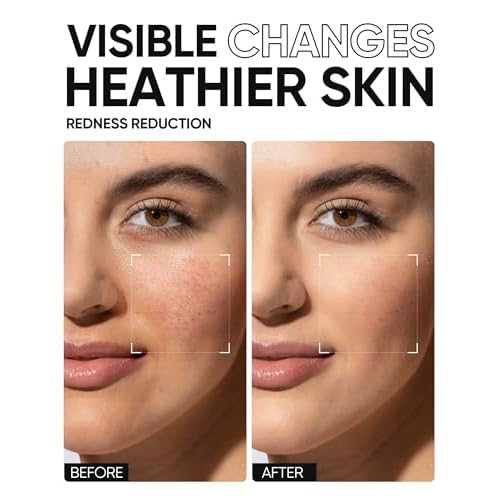 5X Ceramides Moisture Barrier Cream, Hydrating Skin Barrier Repair Face Moisturizer for All Skin Types with Hyaluronic Acid & Centella, Daily Moisturizer, Non-Comedogenic