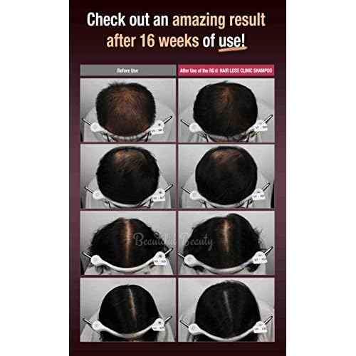 RG3 RGIII RED GINSENG PREMIUM HAIR LOSS PREVENTION SHAMPOO (520ml) + RGIII VOLUME TREATMENT (250ml) set for all gender and age