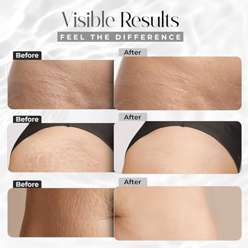 StretchMarkers Therapy Stretch Mark Cream – Retinol & Hyaluronic Acid