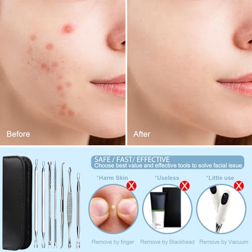 Teenitor 7-in-1 Pimple Popper Tool Kit Stainless Steel Blackhead Remover