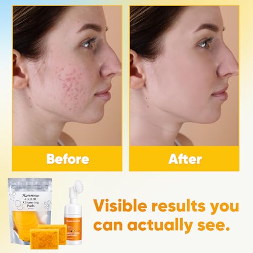 Treeroot 4Pcs Turmeric Face Wash Set: 2Pcs 70g Turmeric Kojic Acid Soap & Turmeric Face Wash with Brush & Turmeric Face Scrub Pads, Face & Body Cleanser, Cleansing Mousse for Deep Cleansing