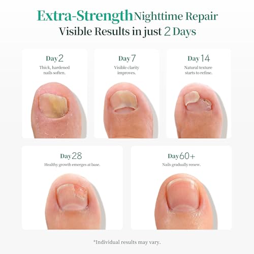 APUREE Fungal Nail Patches - Extra Strength 1% Tolnaftate, 32 Patches