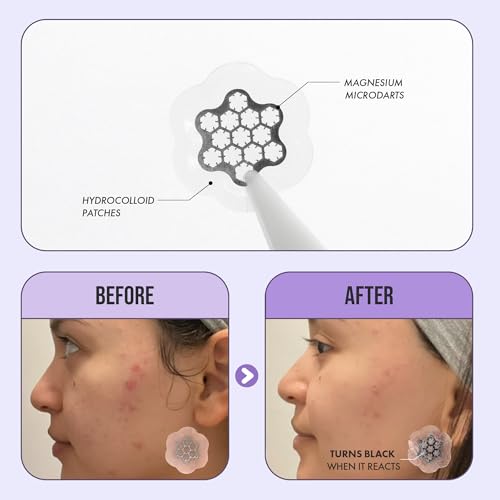 Magnesium Blemish Microdarts | Pimple Patch | Fast-Acting | Quick Calming | 99.9% Pure Magnesium | Madecassic Acid | Tea Tree | Eucalyptus Leaf | Hydrocolloid Spot Care Patch