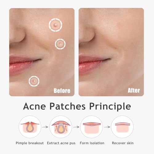Dazzlook 36 Pack Ultra Pimple Patches Variety Set with Salicylic Acid - Discreet Acne Spot Covers for Face & Skin