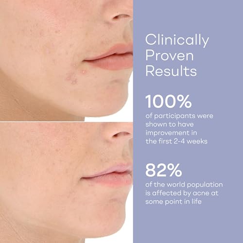 LightStim for Acne LED Light Therapy - FDA Cleared