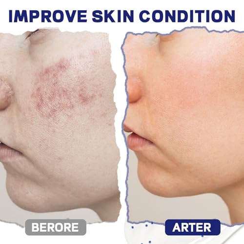 Acne Control Cleanser - Niacinamide & Glycerin, Amino Acid & Salicylic Acid, Dual Seaweed, Gentle Oil Control Face Wash for Normal to Dry Skin, 150g/5.29 Oz