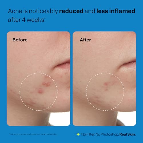 Peach Slices - 3-Step Acne Starter Kit (3 Products) - Skin Care Set - 1 Toner, 1 Cleanser, 1 Oil Free Moisturizer - 2% Salicylic Acid & Botanicals - Vegan & Cruelty Free - Korean Skin Care & Beauty