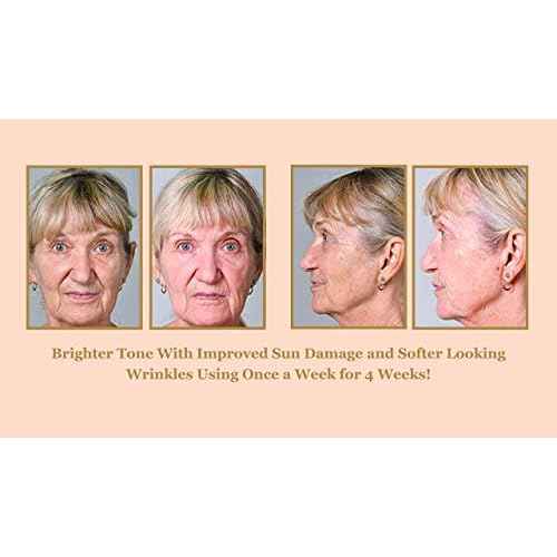 DIAMONDBUFF Microderm Exfoliation Tool for at Home Glowing and Radiant Skin | Reduce Acne, Fine Lines, Wrinkles, & Provide a Velvety Smooth Complexion with Diamond Microdermabrasion