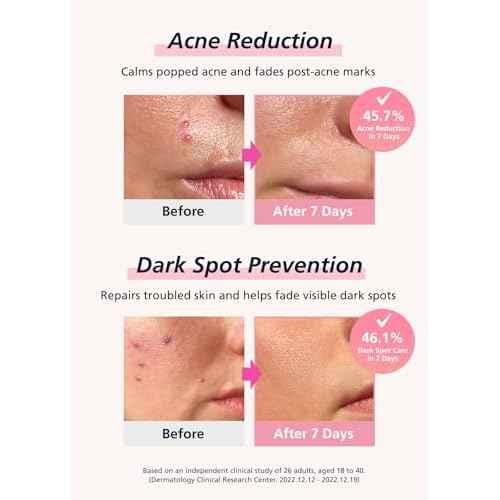 Easyderm Real Calming Patch Pimple Patches, Niacinamide, Hyaluronic Acid, EGF, K-Beauty Skincare | 10 Packs (60 Total) Micro Point length : 285¥ìm