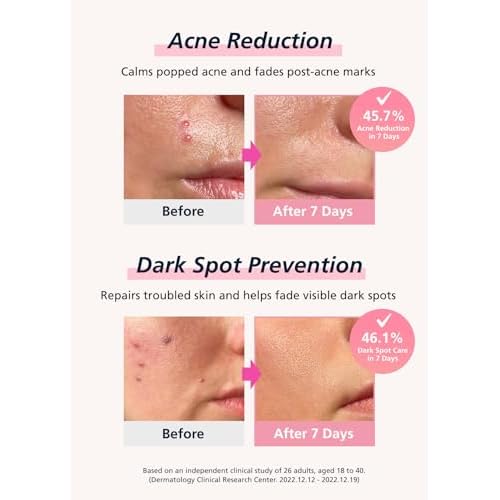 Easyderm Real Calming Patch Microdart Pimple Patches, Clear Nano Micropoint | Niacinamide, Hyaluronic Acid, EGF Acne Dark Spot Care, K-beauty | 12 Counts