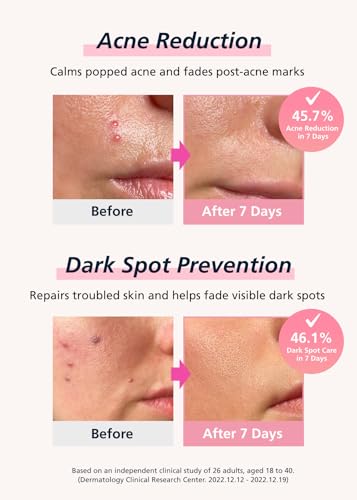 EasyDerm Calming Microdart Pimple Patch 12ea | K-Beauty Acne Spot Treatment