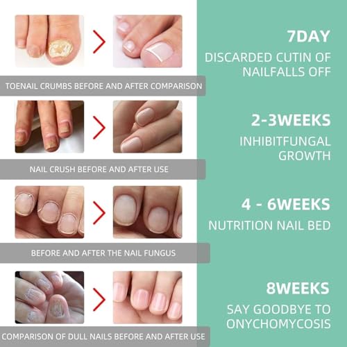 Nail Fungus Treatment Pen - Extra Strength Toenail Repair, 4 Pack