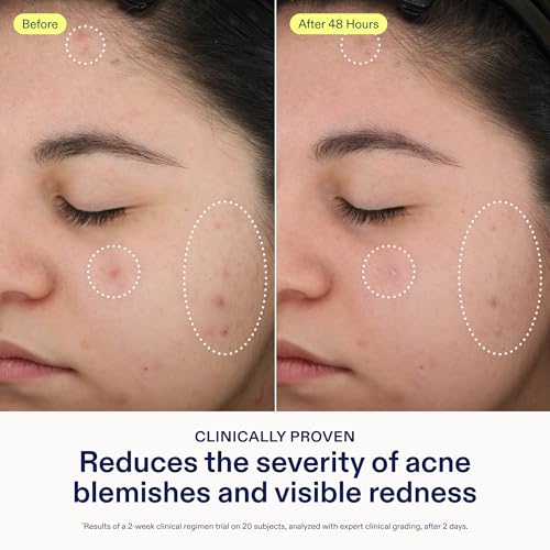 Skinfix 2% BHA Spot Treatment - 0.5 fl oz - Clears Acne Blemishes & Blackheads with Niacinamide - Fragrance Free - Vegan, Cruelty Free